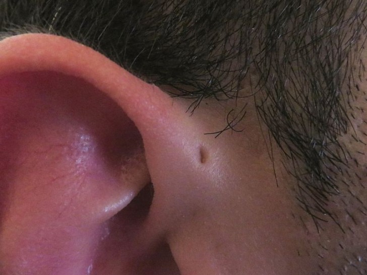 Ce type de malformation congénitale de l' oreille se compose d'une fistule créée par l'absorption manquée des branchies longitudinales pendant la vie embryonnaire.