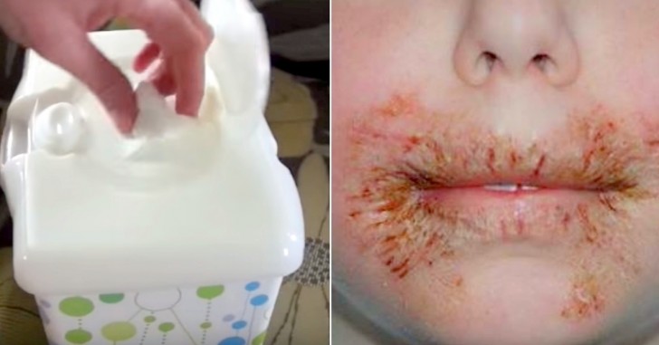 Dermatologists strongly advise against the use of wet wipes on children due to the fact that the chemicals present are innumerable and can trigger allergic reactions.