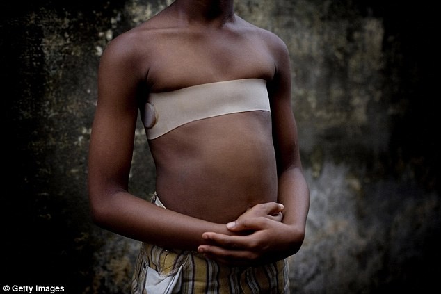 Das Brustbügeln hat ca. 4 Millionen Frauen verunstaltet: Es ist eine traditionelle Praxis in Kamerun, Südafrika und Nigeria.