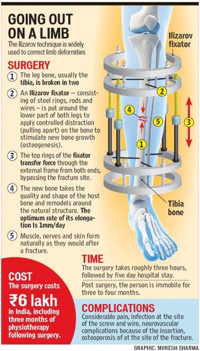 De operatietechniek die wordt toegepast heet de Ilizarovmethode. Het bot van het been wordt gebroken en worden de twee botten uit elkaar getrokken om de botgroei te stimuleren.