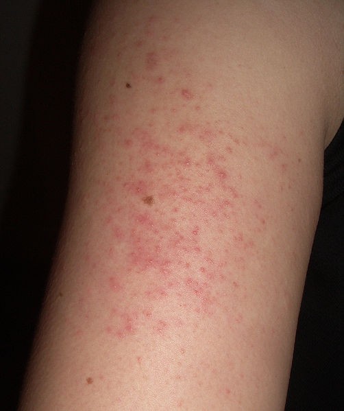 2. Keratosis pilaris