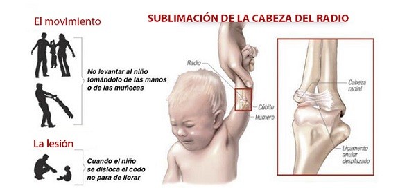 Die Verrenkung des Knochens geschieht in den meisten Fällen aus Achtlosigkeit durch die Eltern heraus. Sie nehmen das Kind am Handgelenk und ziehen es am Arm in die Höhe.