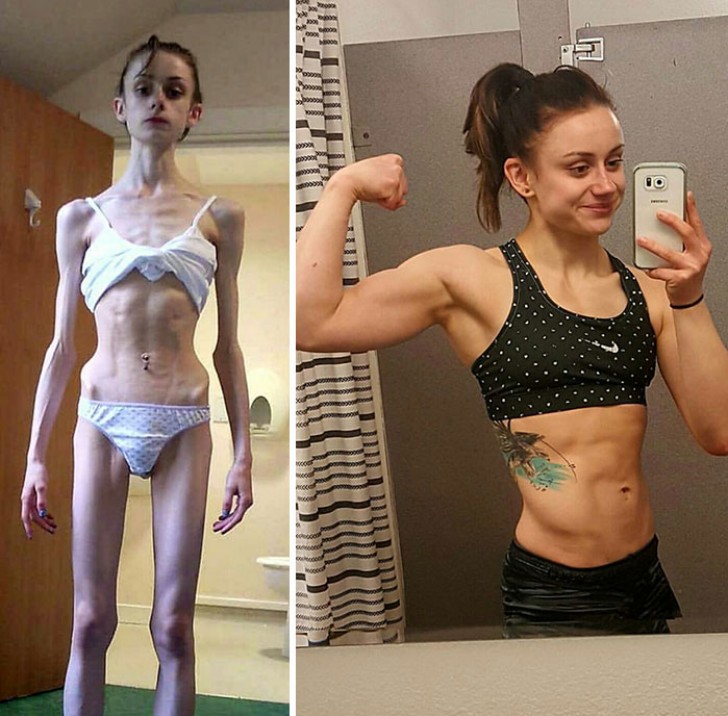 2. Prima e dopo l'anoressia. 
