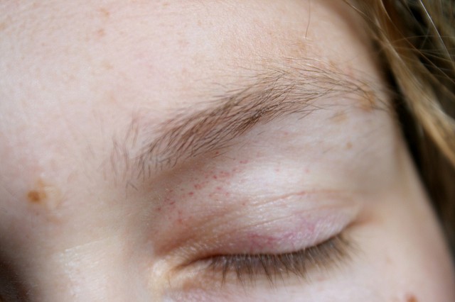 Les spasmes oculaires sont assez fréquents: ils sont habituellement transitoires mais peuvent durer aussi des mois.