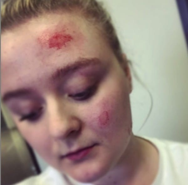 Ela caiu e teve diversas feridas no rosto.