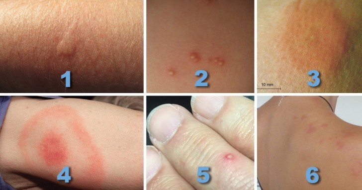 How to distinguish between different bites and what to do if you are stung or bitten.