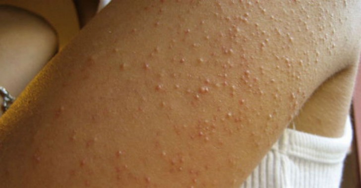 The medical term for skin that looks like a plucked chicken (chicken skin) is keratosis pilaris. These bumps appear in the presence of a condition of inflammation in the body.