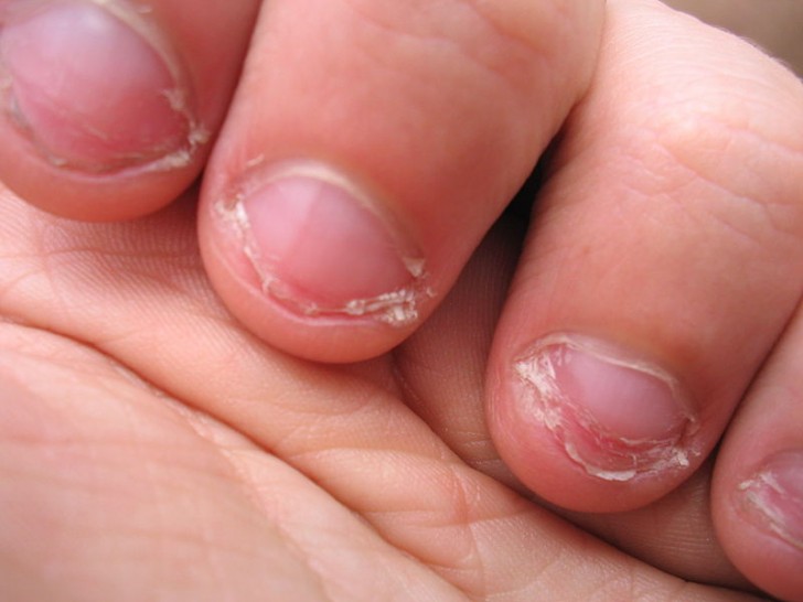 Perfectionists bite and eat their nails to relieve accumulated dissatisfaction.