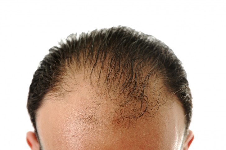 4. Haarverlust