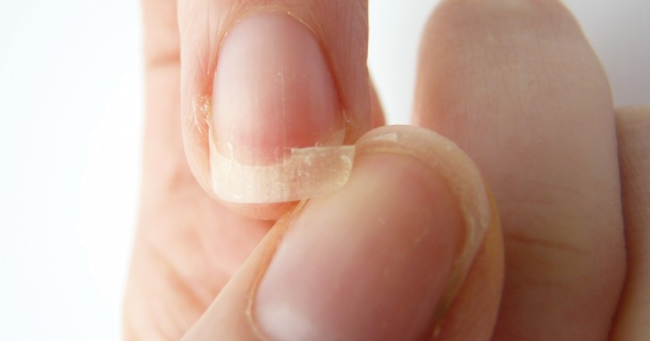 Les ongles qui se cassent témoignent d'une carence en manganèse.