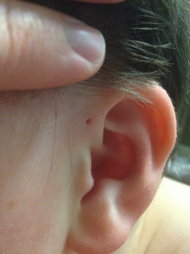 8. Born with a hole on some part of an ear.