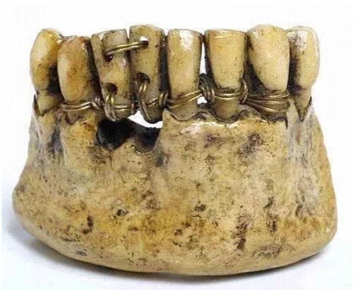 A dental prosthesis in ancient Rome made of gold...