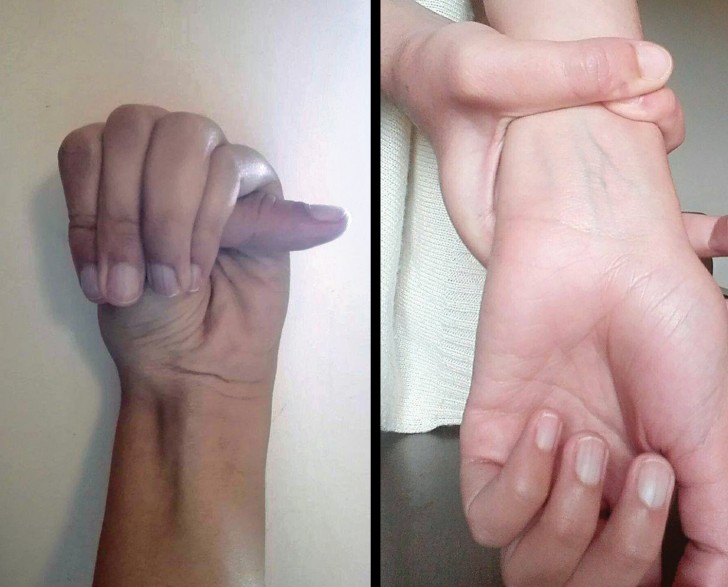 Se sai fare questo con le mani potresti avere la sindrome di Marfan - 2