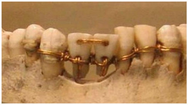 13. Eine antike Zahnbehandlung.