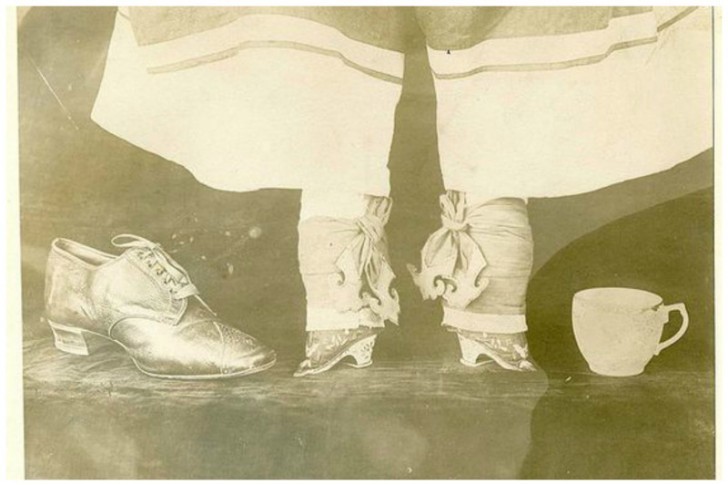 3. The outdated Chinese tradition called "foot binding" that once reduced the size of women's feet as an indication of social status and beauty.