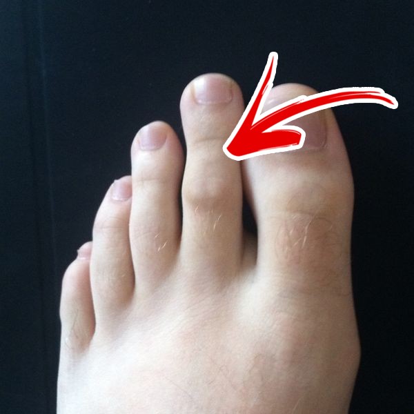 8. Greek foot aka Morton's toe