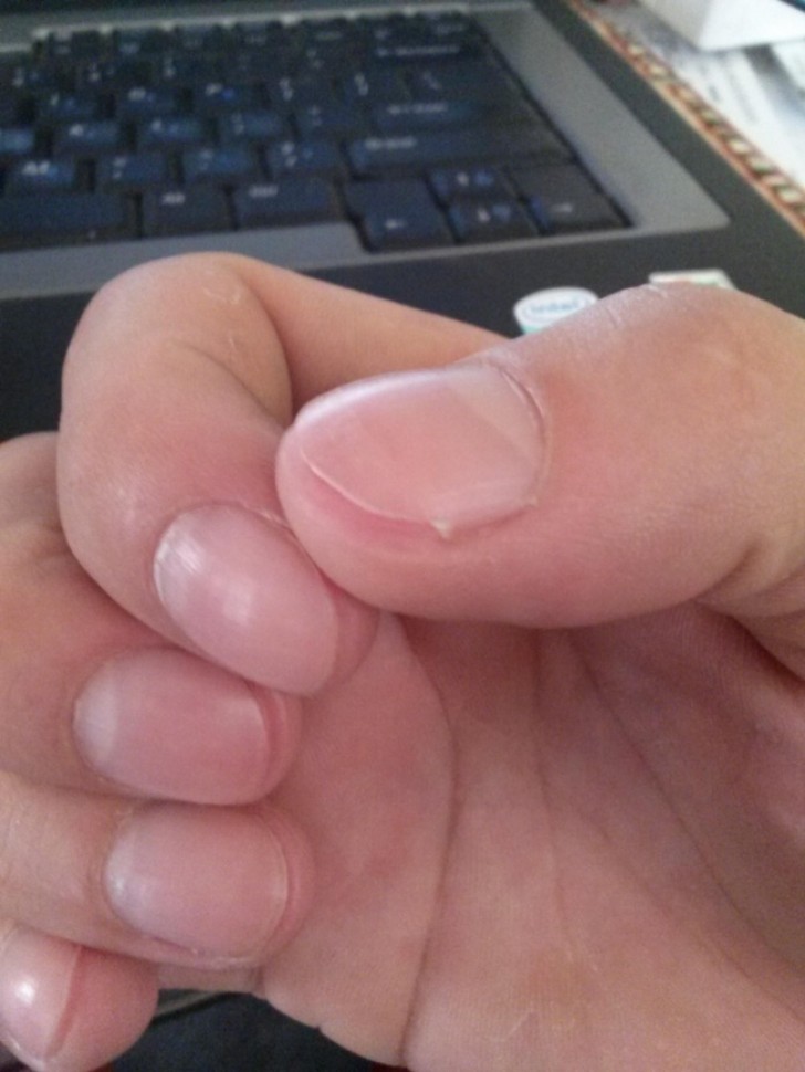 The pain that comes when you cut your fingernail too short.