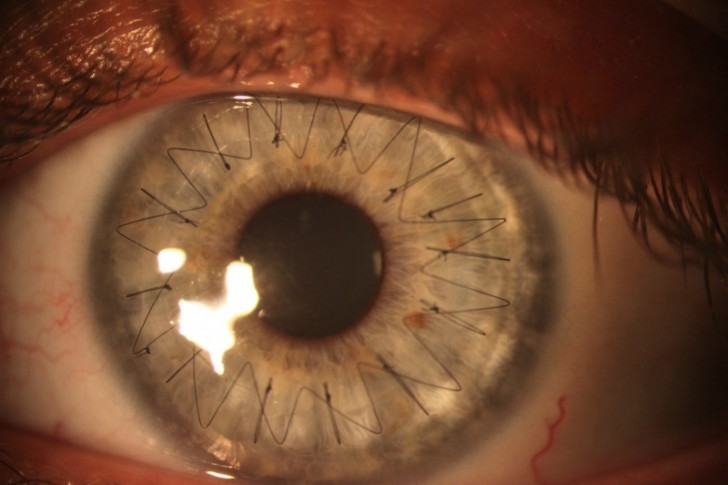 An image captured during a cornea transplant.