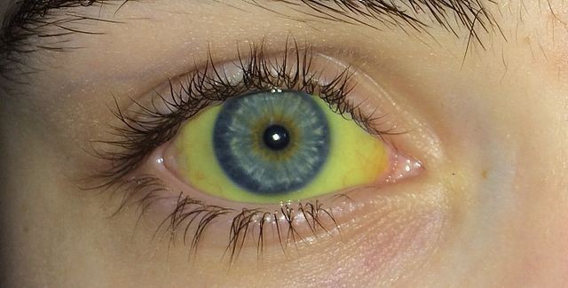 5. Gele kleur in de ogen (geelzucht)