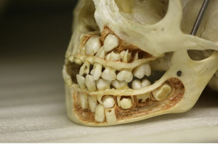 Il cranio di un bambino prima della perdita dei denti da latte.