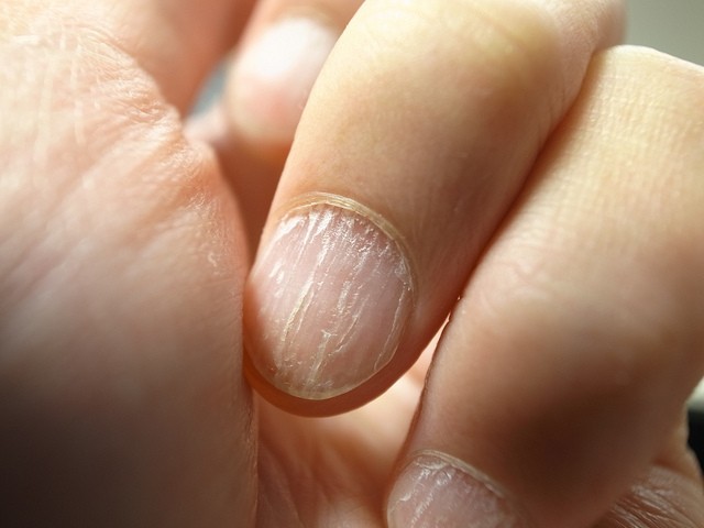 Zwakke of gegroefde nagels