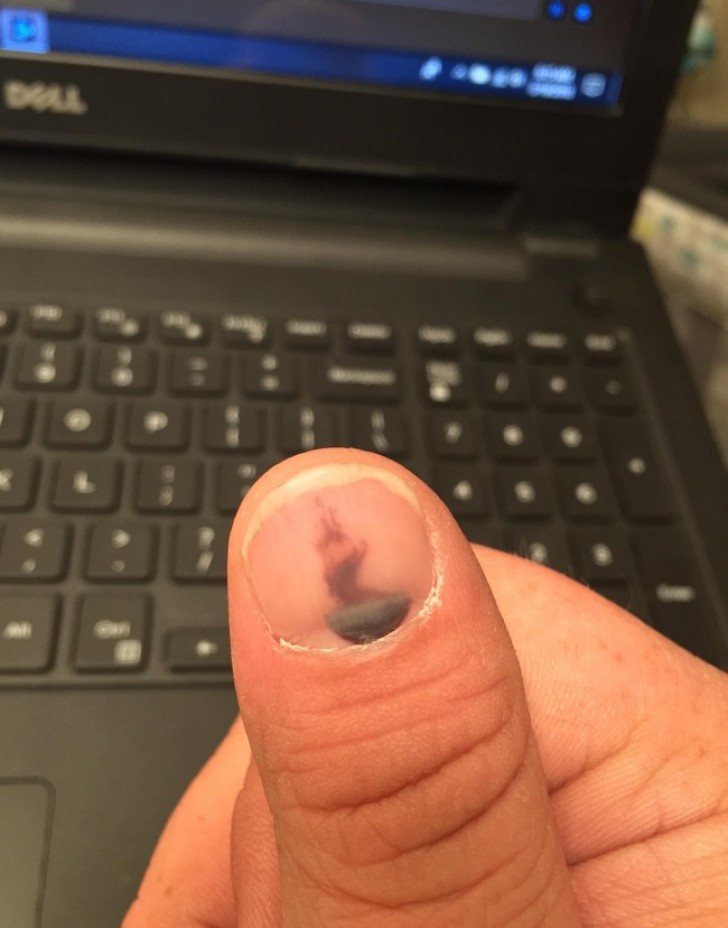 Dit hematoom op de nagel lijkt op een bord dampende soep...