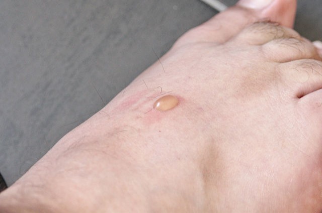 3. Orsakar blåsor och exponerar foten för infektioner och sår.