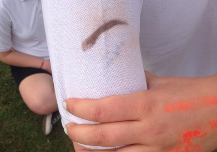 2. "Mein Freund und ich kollidierten während eines Spiels und seine Augenbrauen blieben auf meinem Shirt".