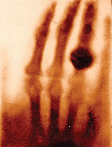 Eine der ersten Röntgenplatten, 1895.