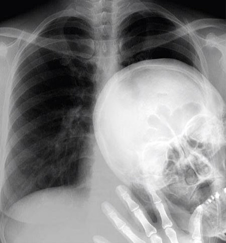 13. Photobomber "Radiographie"