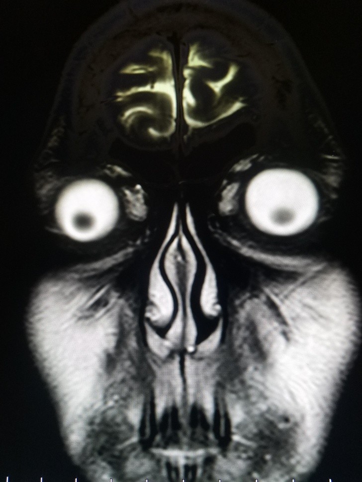 6. Een ijzingwekkende MRI-scan van een hoofd