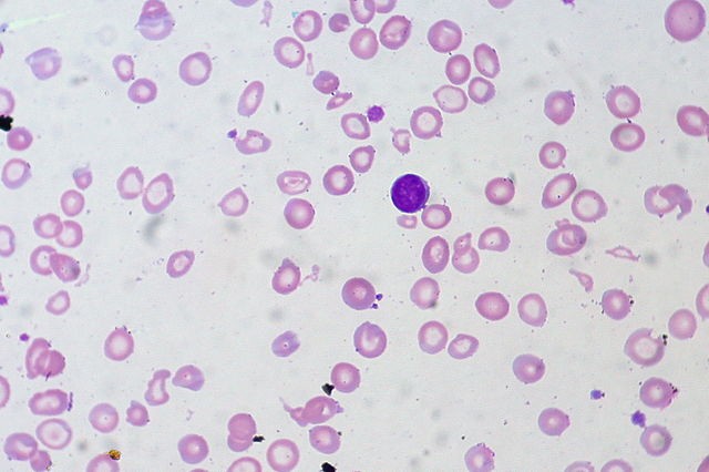 8. Anemia de carencia de hierro