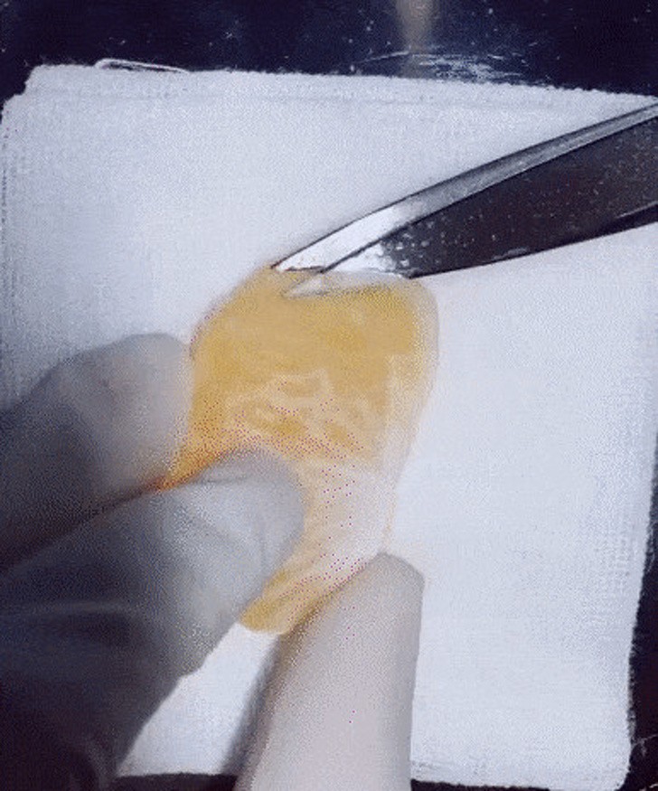 15. Exercice chirurgical sur une tranche de mandarine