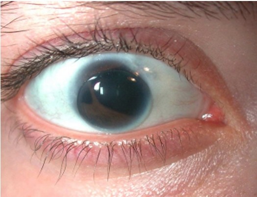 12. La policoria è quando all'interno dell'occhio si hanno due o più pupille!