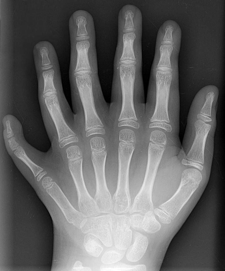 5. Röntgenaufnahme der Hand einer Person mit Polydaktylie