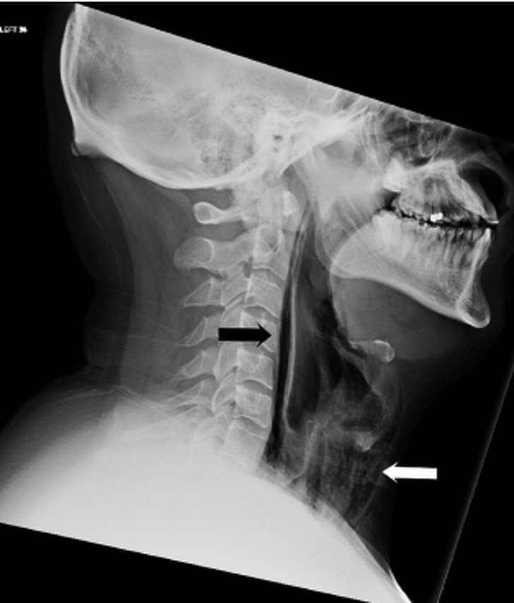 6. Un uomo ha aperto un piccolo buco nella sua trachea tappandosi il naso e tenendo chiusa la bocca durante uno starnuto. È stato in ospedale per due settimane
