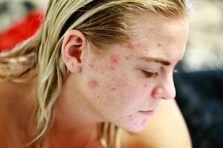 3. Het veroorzaakt huidproblemen.