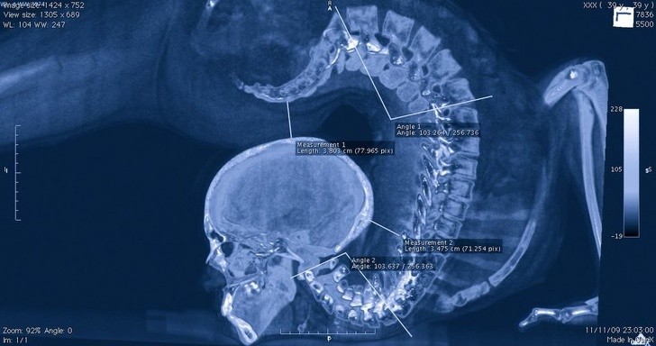 7. Een slangenmens die op zijn hoofd zit? De röntgenfoto is afkomstig van een wijd open mond