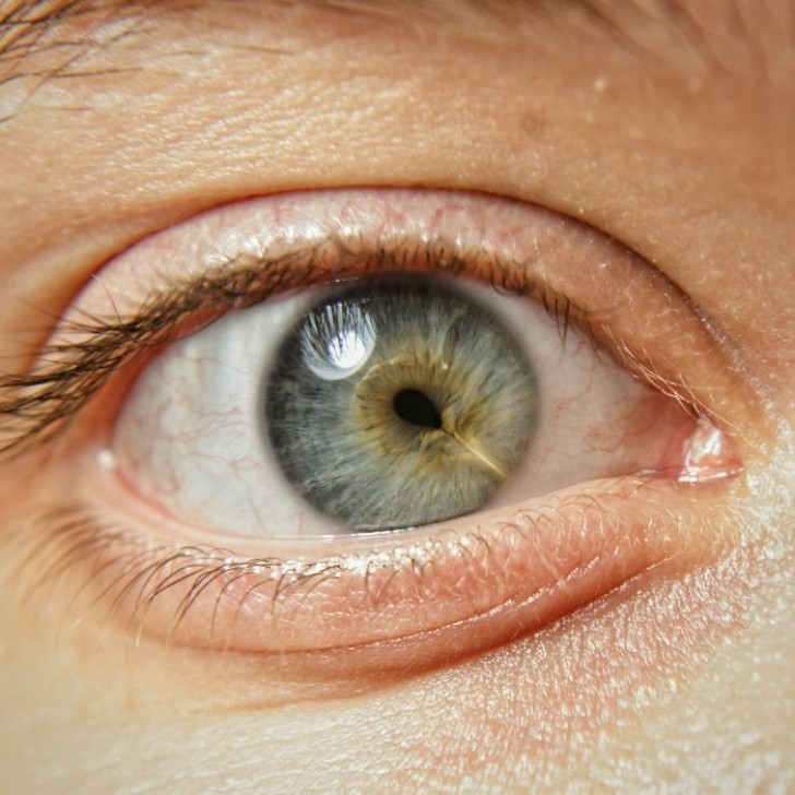Eine Narbe im Auge? Es wird als Makula-Falte bezeichnet und besteht aus der Entwicklung einer Membran, die sich bei Kontraktion verdickt und eine Verschlechterung des Sehvermögens verursacht.