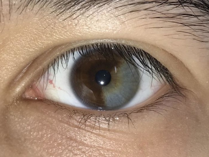 Zweifarbiges Auge: Es wird sektorale Heterochromie genannt und ist eine Erkrankung, die vererbt werden kann oder die als Folge eines Traumas auftreten kann.