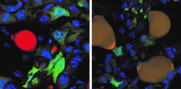 Cellules tumorales (en vert fluorescent, à gauche) transformées en cellules graisseuses (en marron, droite)