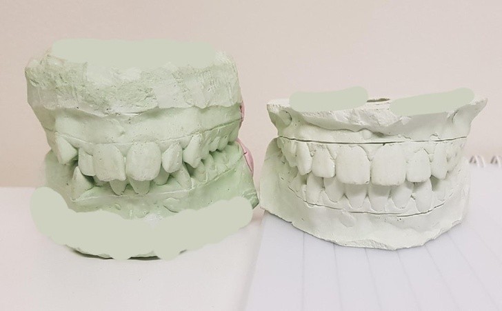 8. Vor und nach der Zahnspange