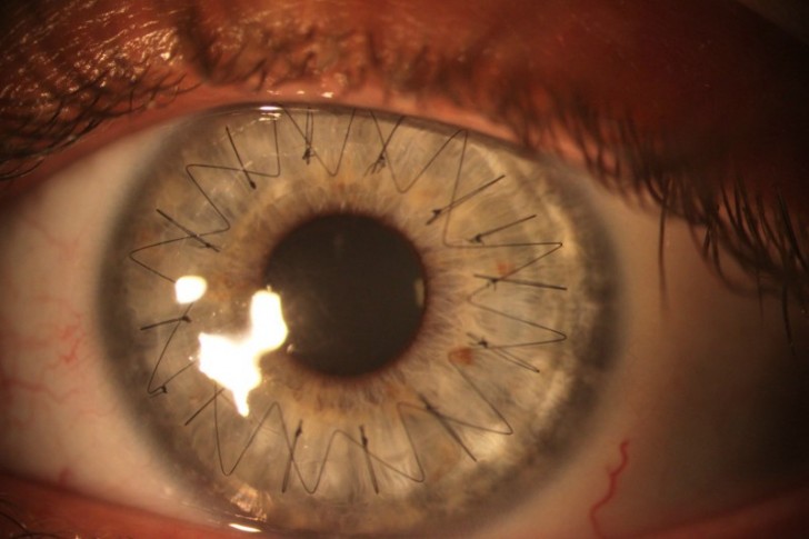 4. Dit is hoe een oog eruit ziet nadat het een hoornvliestransplantatie heeft ondergaan