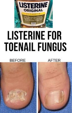 1. Per curare i funghi dei piedi
