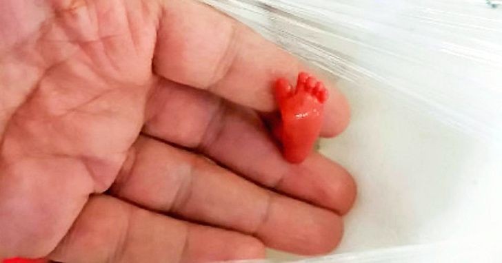 An infant born prematurely surviving despite all odds