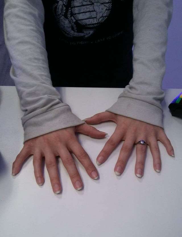 Eine Kundin kam in den Laden und zeigte mir ihre genetische Besonderheit: Sie hat 6 Finger an jeder Hand!