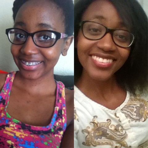 3. Zwei Jahre Zahnspange und Gesichtspflege: Der Unterschied ist enorm und jetzt fühlt sich dieses Mädchen viel wohler!