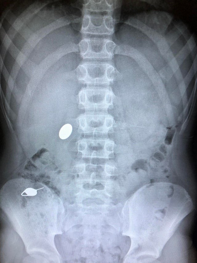 My son swallowed a quarter after showing his little brother how he swallowed my smartphone's USB reader...