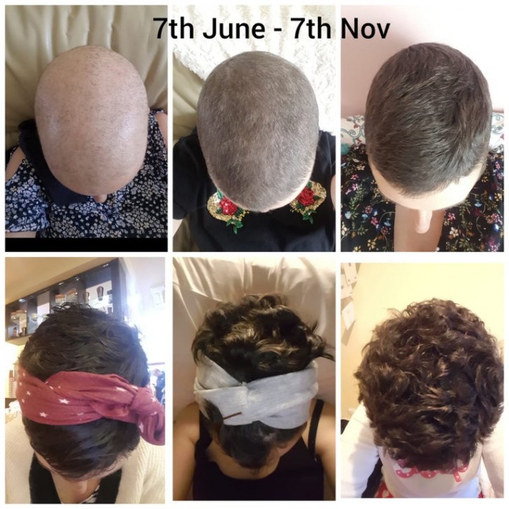 My wife has been taking photos of her head every month since her last chemotherapy treatment... she did it!