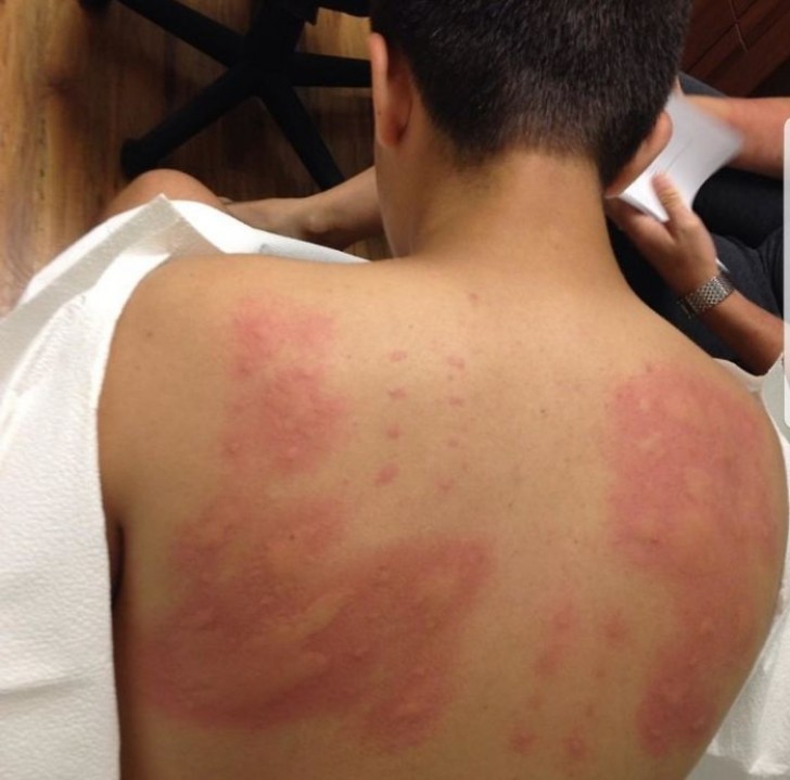 This boy underwent allergy testing and was found to be allergic to virtually EVERYTHING.